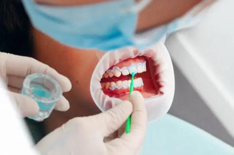 دليلك الشامل حول أنواع تجميل الأسنان