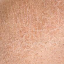 حلول جفاف الجلد : نصائح لبشرة ناعمة ومرطبة